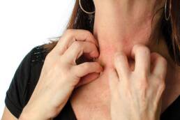 La dermatite può accentuarsi durante periodi di maggiore stress per l’organismo