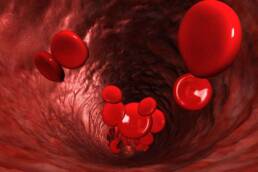 L'ipertensione arteriosa è caratterizzata dall'elevata pressione del sangue nelle arterie