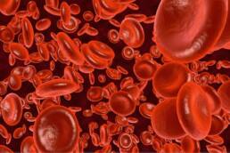L’anemia comporta una carenza di emoglobina nei globuli rossi
