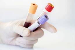 Per diagnosticare l’anemia vengono effettuati degli esami del sangue