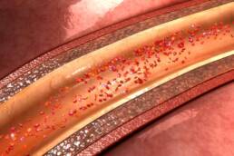 L'aterosclerosi causa alterazioni della parete arteriosa tramite deposito lipidico