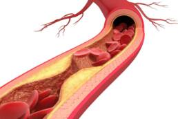L’arteriosclerosi causa una progressiva riduzione delle arterie