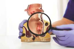 La colite ulcerosa si differenzia in base al tratto d’intestino colpito