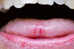 L’allergia ad alcuni batteri presenti nella bocca può causare le afte