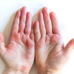 Come curare le ragadi di mani e piedi